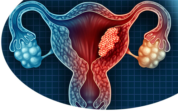 Rahim Kanseri (Endometriyal Kanser – Uterus Kanseri)